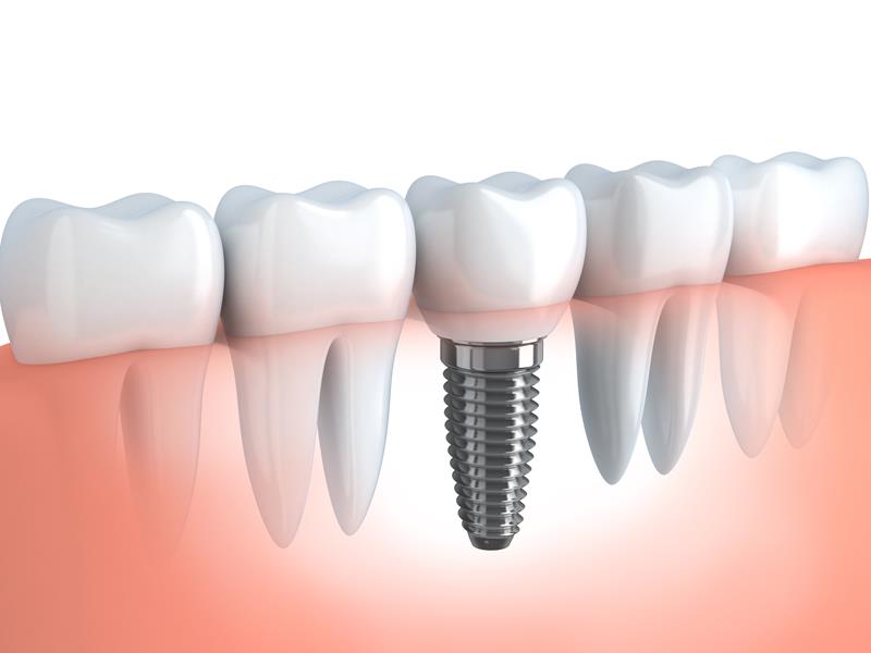 Dental Implants  Salem, UT 